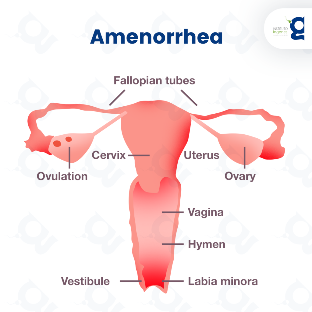 Amenorrhea