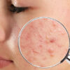 Best Homeopathy Medicine For Acne