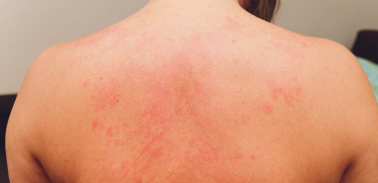 ত্বকের অ্যালার্জি (Skin Allergy) ও এর হোমিওপ্যাথি চিকিৎসা